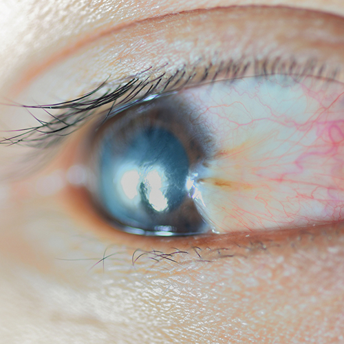 Pterygium Surgery